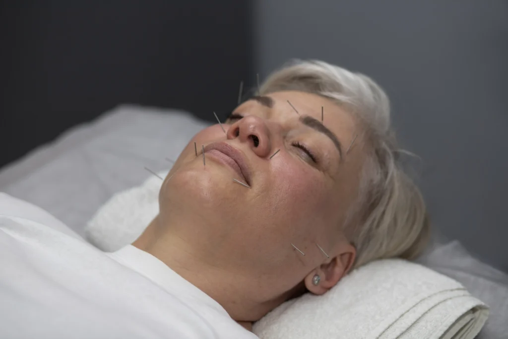 high angle smiley woman acupuncture treatment